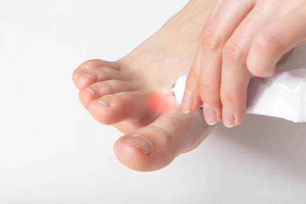 Girl Applies Healing Ointment Toes Fungus Sweating Feet Close — Stock Photo, Image