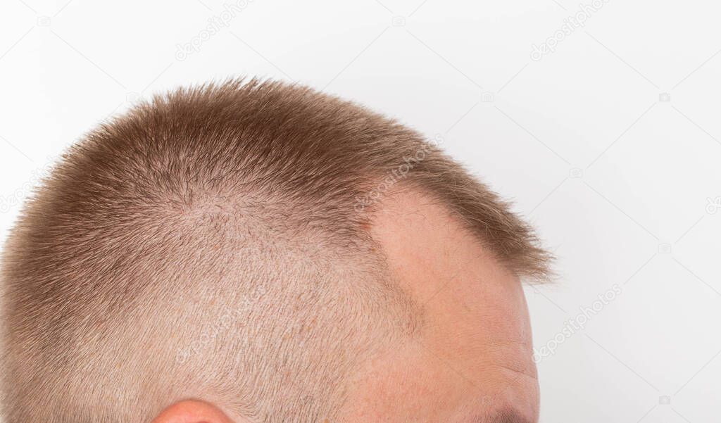 Bald patches on the head of a young man. The concept of the increased hormone dihydrotestosterone. Weakening of hair follicles, healthcare