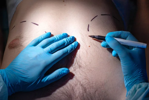 Doctor plastic surgeon makes marks with a felt-tip pen for plastic surgery to correct male breast, close-up. Gynecomastia