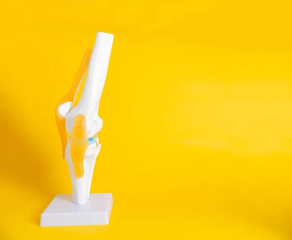Articulación de rodilla maqueta sobre fondo amarillo. Concepto de artroplastia de rodilla con implantes. Copiar espacio para texto, reemplazo — Foto de Stock