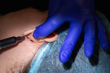 Estetik cerrah, kadın bir hastanın kulaklarını düzeltmek için ameliyat eder. Otoplasti, dışarı fırlayan kulakların elenmesi, estetik ameliyat