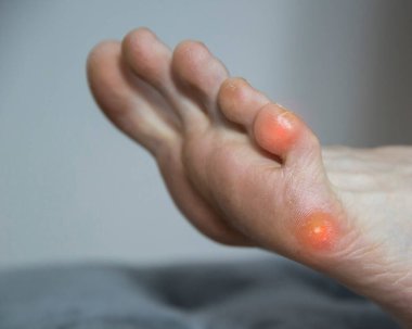 Ayakta ayak ve insanlarda ayak parmağı siğili. Dermatolojide tabanda siğillerin tedavisi ve çıkarılması.