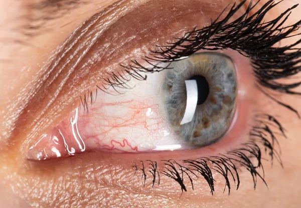 Occhio Arrossato Infiammato Una Ragazza Primo Piano Dilatazione Dei Vasi — Foto Stock
