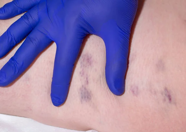 의사는 정맥류 혈전증을 환자의 다리를 검사합니다 — 스톡 사진