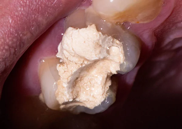 歯の運河の治療に一時的な充填のインストール 内因性 歯医者における歯のパルピティス — ストック写真