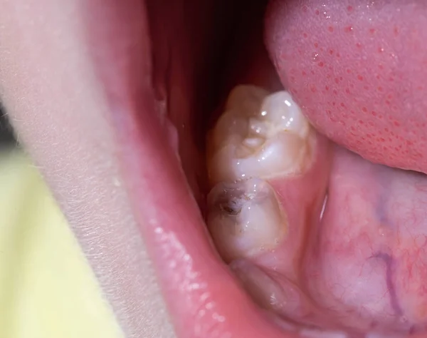 赤ちゃんの歯には クローズアップを運ぶ 現代の歯科 マクロの子供のための歯科治療の概念 — ストック写真