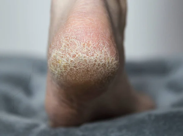 Suchá Kůže Prasklinami Patě Nohy Člověka Detailní Záběr Léčba Kalené — Stock fotografie