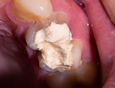 Sinir hasarı ve pulpitis tedavisi için geçici dolgusu olan diş. Stomatoloji