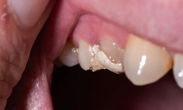 Зуб с временной начинкой для разрушения нервов и лечения пульпита, макро. Стоматология — стоковое фото