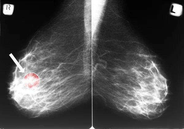 Mammogramm mit Brustkrebs Stockbild