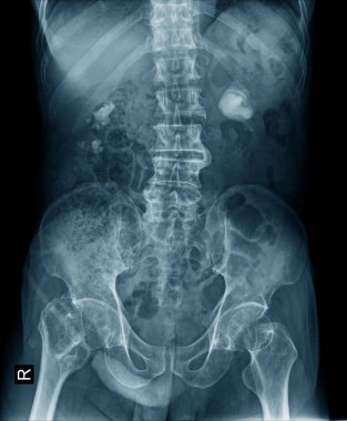 Renal kalkülüs ya da böbrek taşı x-ray resmi mavi tonda