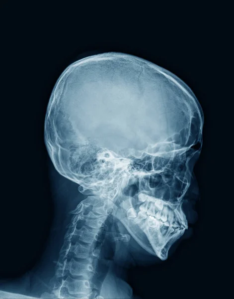 Cráneo Humano Rayos Azul Sobre Fondo Oscuro — Foto de Stock