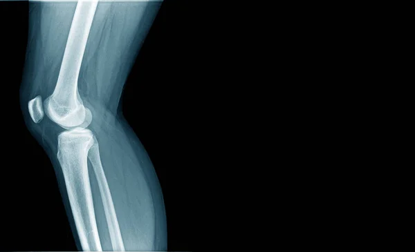 Рентгенівське Зображення Ого Колінного Суглоба Синього Кольору Простором Копіювання — стокове фото