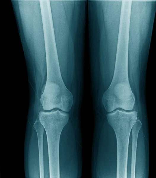 Колінний Суглоб Рентгенівське Зображення Синьому Тоні — стокове фото