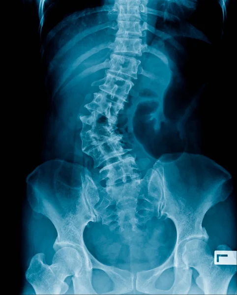 腹部のX線画像は 脊椎と骨盤の骨 腰椎の脊椎炎と変性の変化と変形を示しています — ストック写真