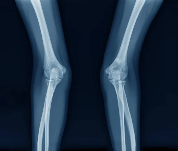 elbow joint x ray image in blue tone