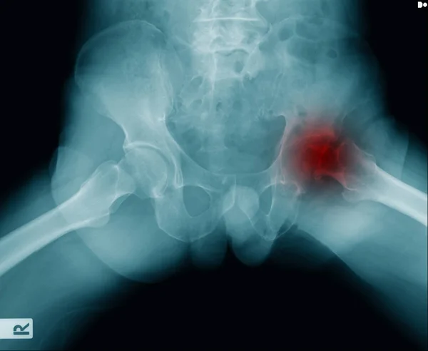 hip fracture at intertrochanteric of femur bone