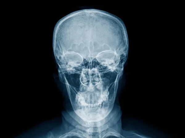 Cranio Umano Raggi Sfondo Nero — Foto Stock