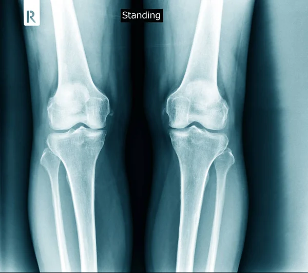 knee joint x ray in blue tone