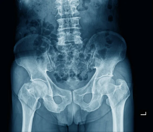 pelvic bone x ray in blue tone