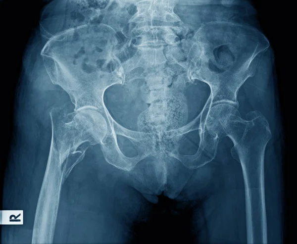 x ray image of pelvic bone with part of lumbar spine