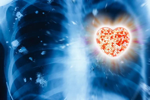 x-ışını ve kalp