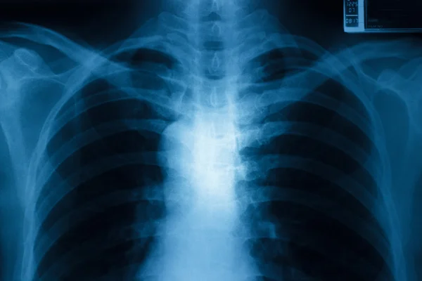 Bröstkorgsröntgen — Stockfoto