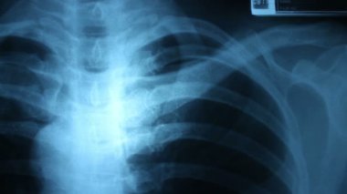 x-ray görüntü resmini Dolly
