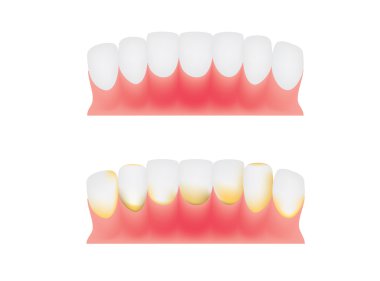 diş ve diş eti, dental plak