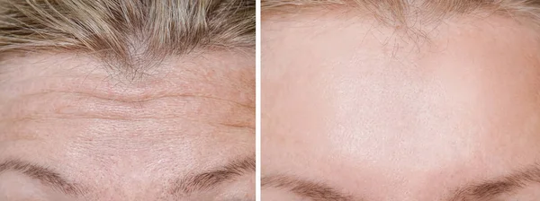 Stirnfalten im weiblichen Gesicht vor und nach der Behandlung, Verjüngung und Antiaging beim Kosmetologen und Dermatologen, plastische Chirurgie — Stockfoto