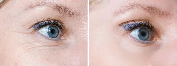 Forehead wrinkles on female face before and after treatment, rejuvenation and antiaging procedures at cosmetologist and dermatologist, plastic surgery — Stock Photo, Image