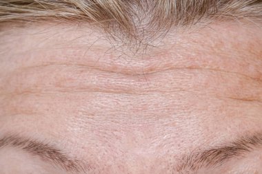 Kadın, rejuvasyon işlemleri, enjeksiyonlar, tedavi, ameliyat öncesi alnında kırışıklıklar var..