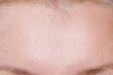 Yenilenme işlemleri, enjeksiyonlar, tedavi, ameliyat sonrası alnında kırışıklıklar var.