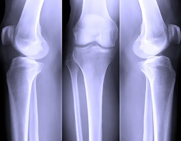 Knee x-ray — Stock Photo, Image