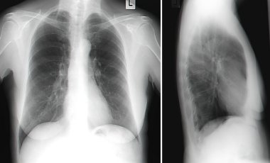İnsan Göğsünün X-Ray Görüntüsü