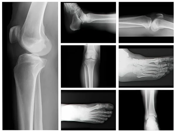 Röntgenbilder menschlicher Beinknochen — Stockfoto