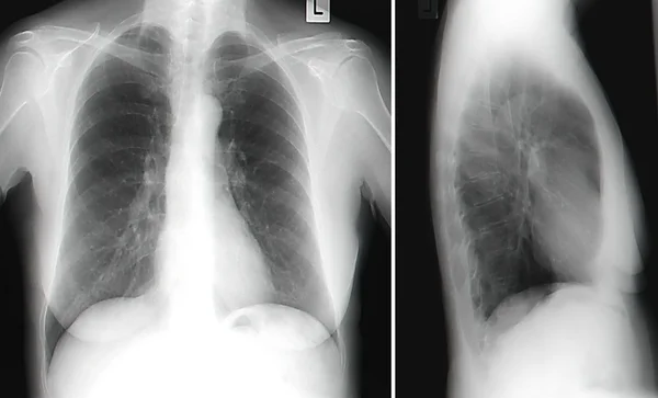 İnsan Göğsünün X-Ray Görüntüsü — Stok fotoğraf