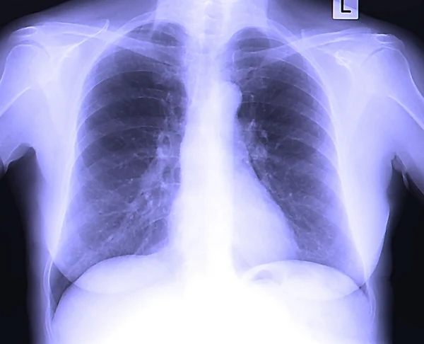 人类胸部的X射线图像 — 图库照片