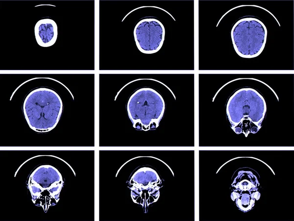 大脑的 x 射线图像计算机断层扫描 — 图库照片