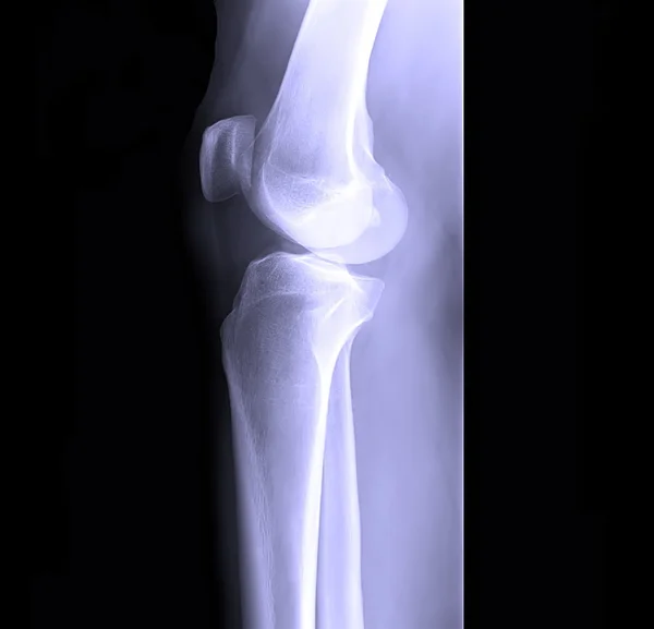 Rentgenowskie kości ludzkich nóg — Zdjęcie stockowe