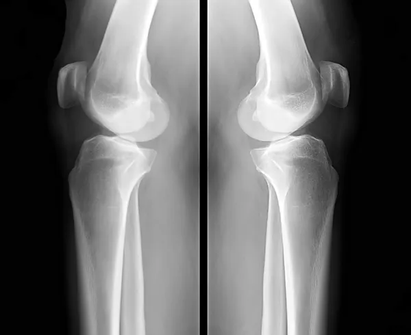 Human leg bone X-rays — Stock Photo, Image