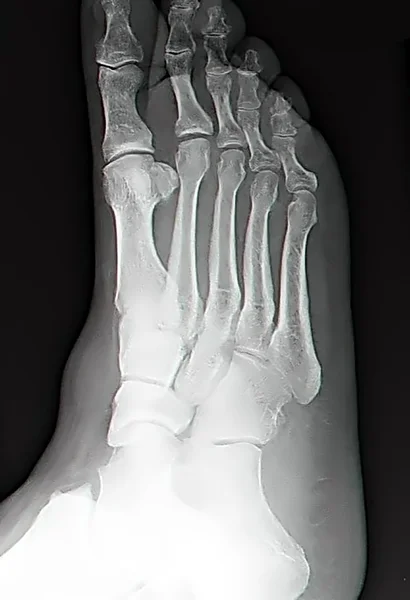 Human leg bone X-rays — Stock Photo, Image