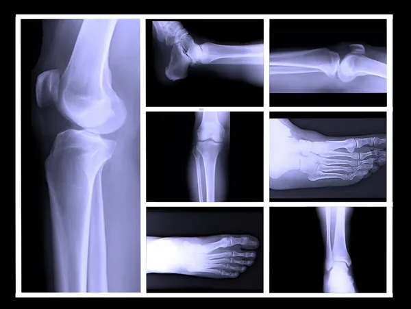 Human leg bone X-rays — Stock Photo, Image