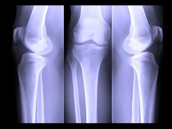 人体腿部骨 x 射线 — 图库照片