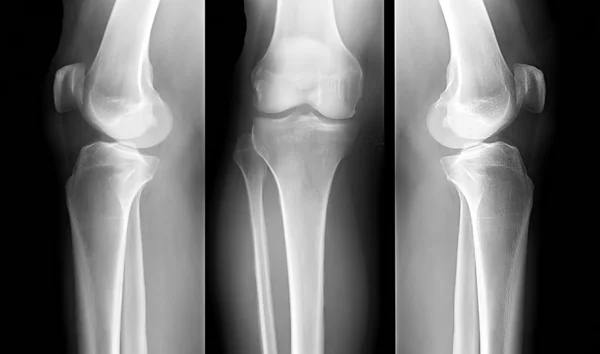 Raio-X dos ossos das pernas humanas — Fotografia de Stock