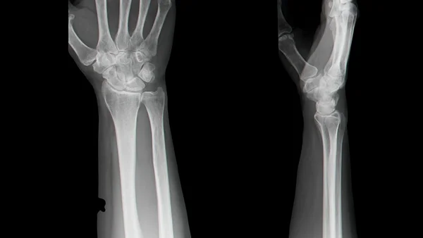 X 射线的手 — 图库照片