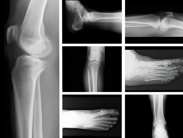 Human leg bone X-rays — Stock Photo, Image