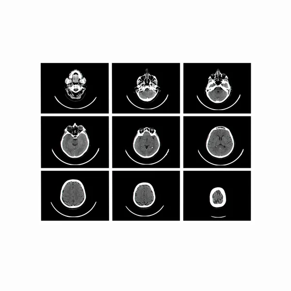 Рентгеновское изображение компьютерной томографии мозга — стоковое фото