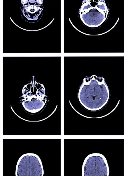 大脑的 x 射线图像计算机断层扫描 — 图库照片