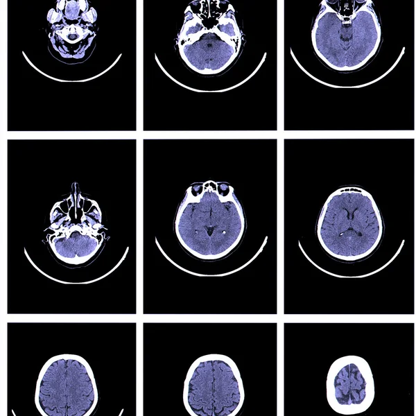 Imagen de rayos X de la tomografía computarizada cerebral —  Fotos de Stock